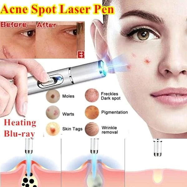 Acne Wrinkle Removal Laser Pen Skin